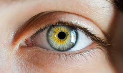 What Causes Macular Degeneration